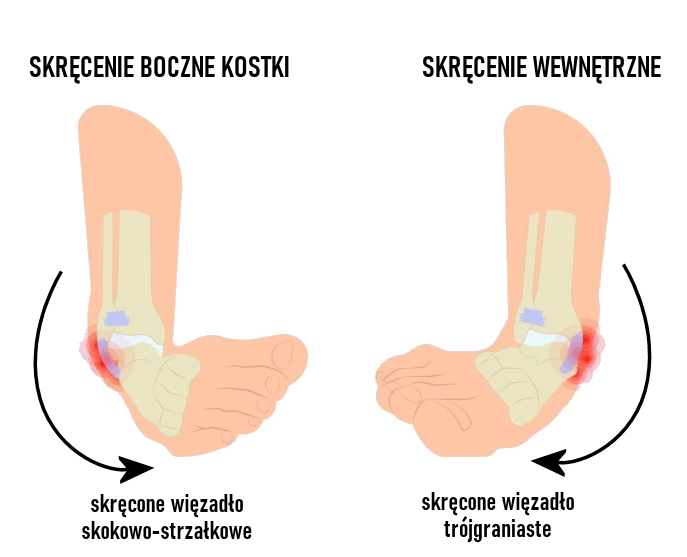 Skręcenie A Zwichnięcie Kostki – Na Czym Polega Różnica